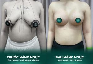 V1 trước và sau thẩm mỹ