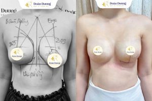 Giải pháp khắc phục dáng ngực lệch