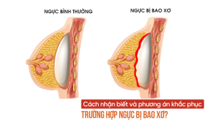 Phương án khắc phục ngực bị bao xơ